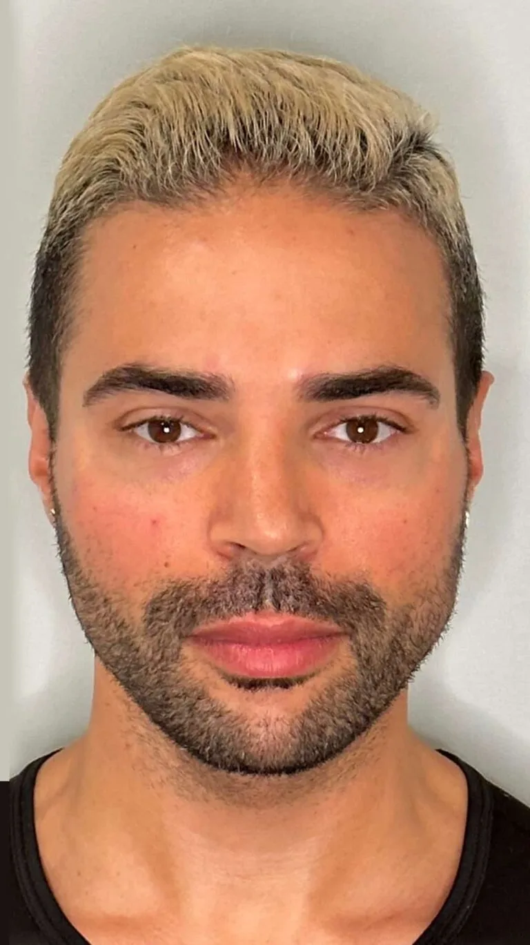 After Image: Chin and Cheek filler - front