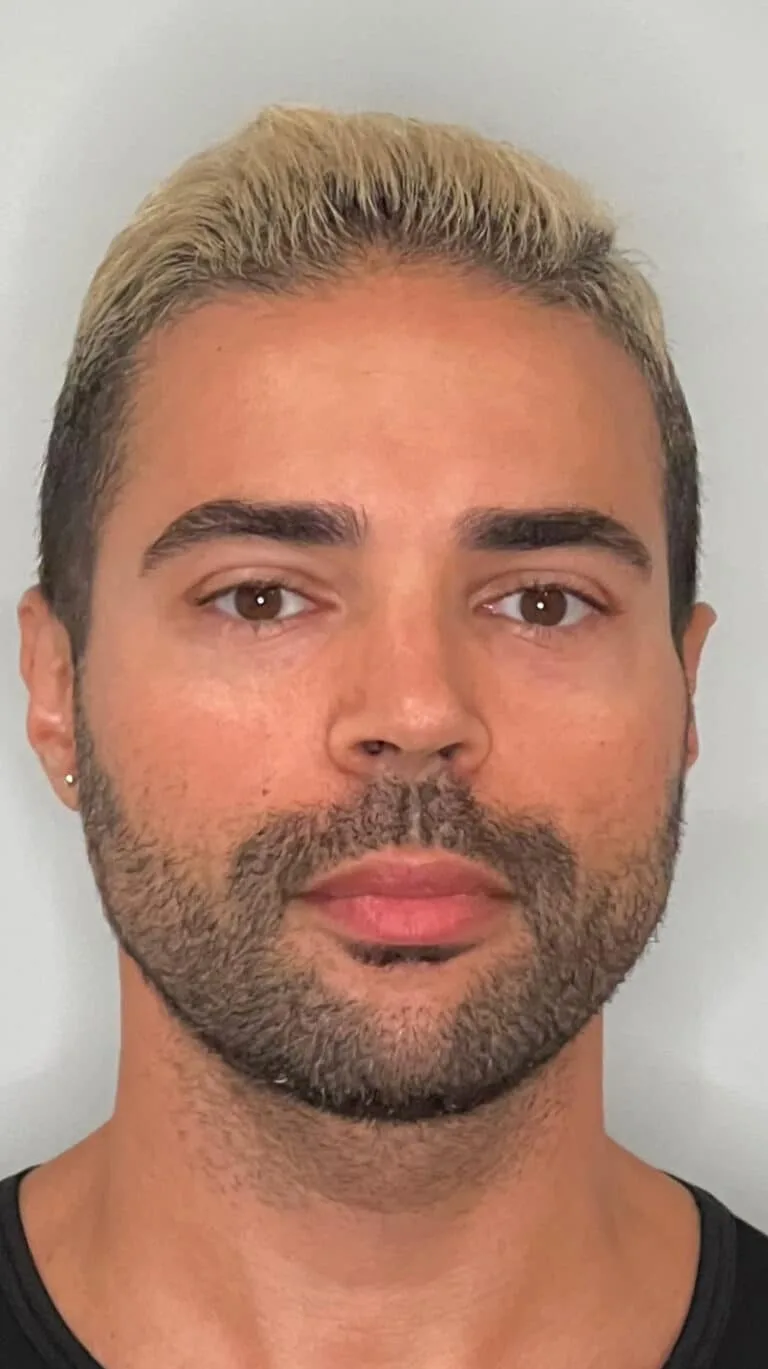Before Image: Chin and Cheek filler - front