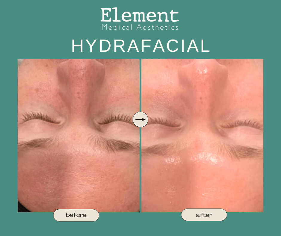Copy of Hydrafacial .png