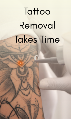 Tattoo Removal Takes Time