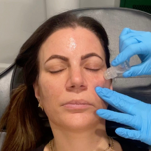 Rosacea