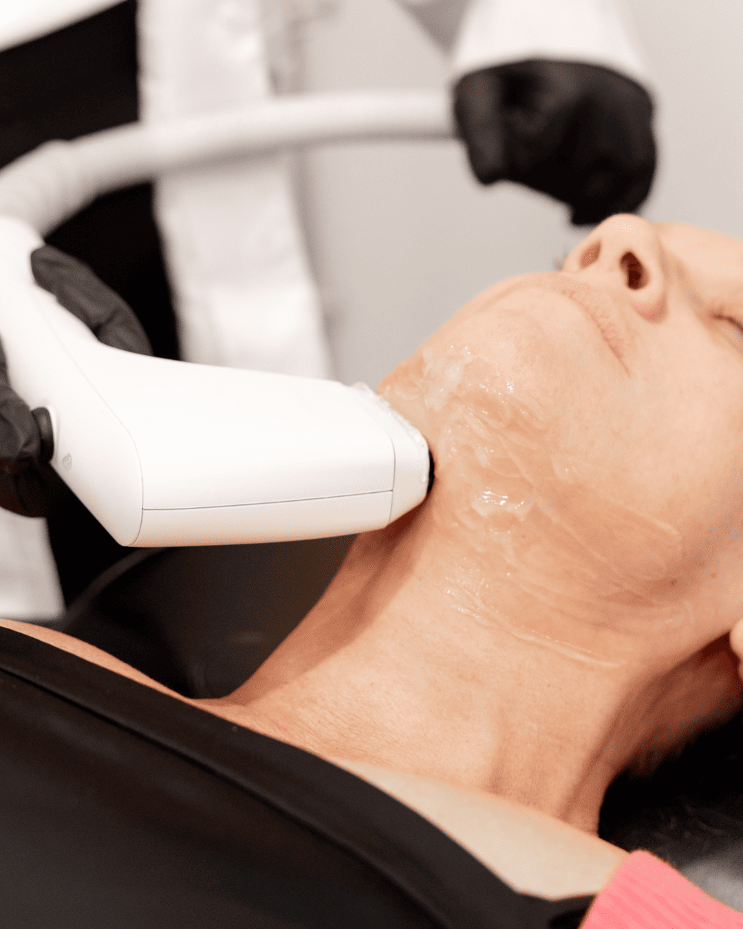 Sofwave Neck Sofwave Neck