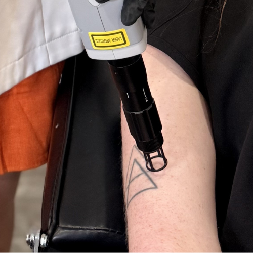 Tattoo Removal